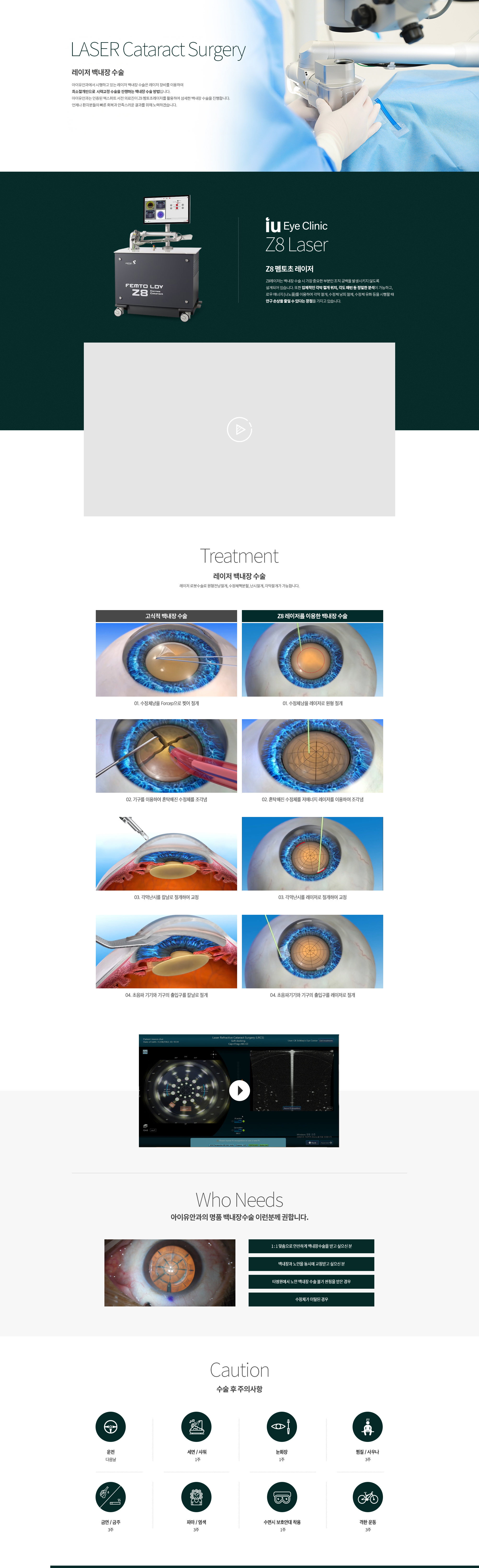 레이저 백내장 수술