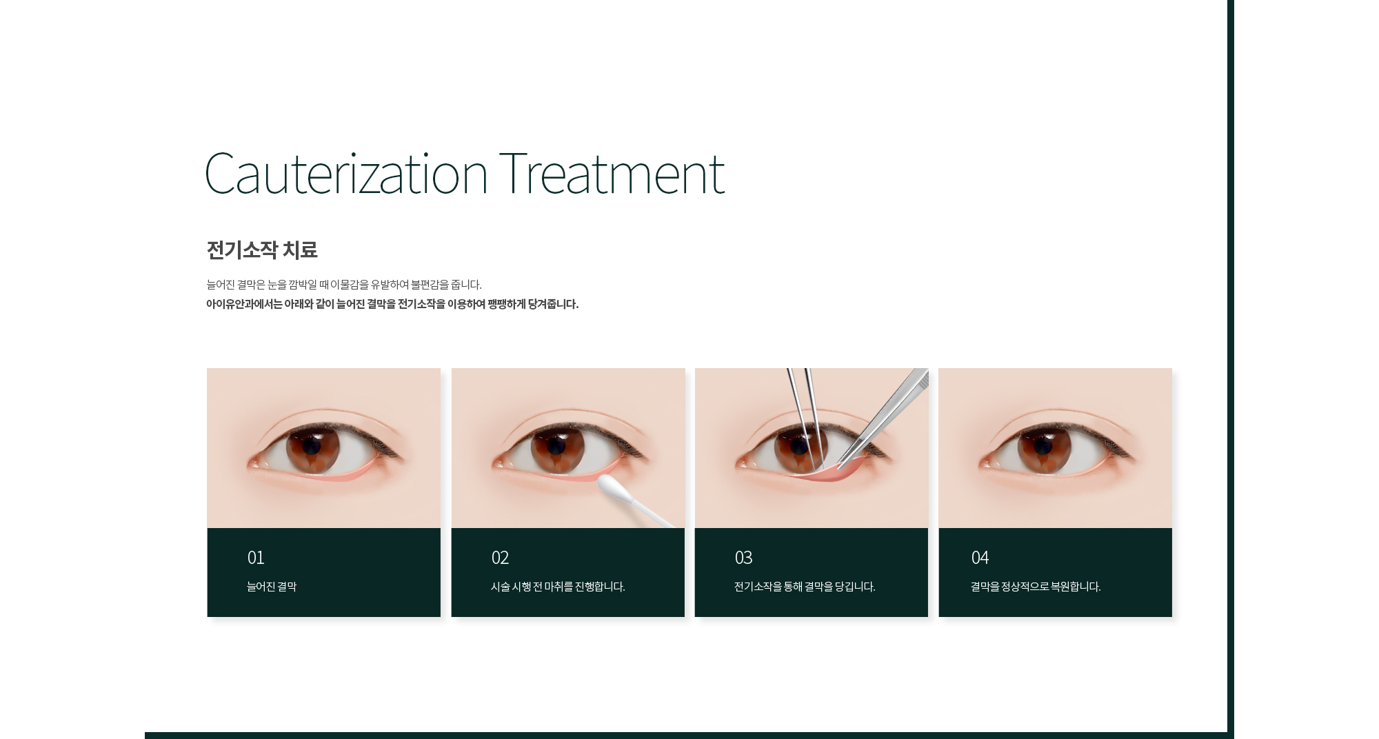전기소작(cauterization) 치료